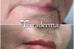 Lip Liner Permanent Makeup - Terraderma July 2020