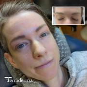 Nanaimo Microblading 2026 - Terraderma